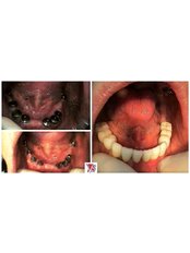 Dental Implants - VB Dental Clinic