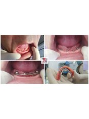 All-on-4 Dental Implants - VB Dental Clinic