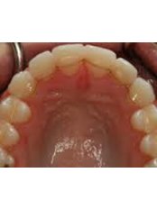 Orthodontic Retainer - Compass Dental Care