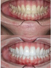 Teeth Whitening - Brighton Dental Suite