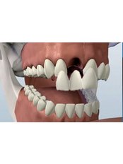Dental Bridges - Brookwater Dental Surgery