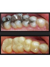 Fillings - Brookwater Dental Surgery