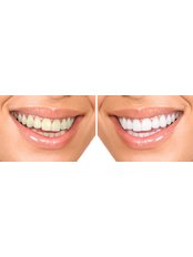 Teeth Whitening - Brookwater Dental Surgery