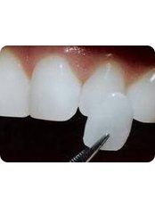 Veneers - Raceview Dental Surgery