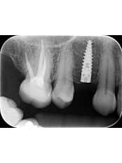 Dental Implants - Raceview Dental Surgery