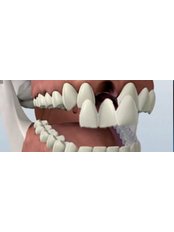 Dental Bridges - Paradise Smiles Dental Surgery