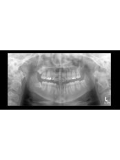 Wisdom Tooth Extraction - Paradise Smiles Dental Surgery
