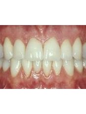 Denture Care Professionals Australia - Natural Looking Dentures 