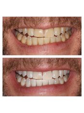 Zoom! Teeth Whitening - Perfect Smile