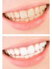 Teeth Whitening - Phillip Island Dental