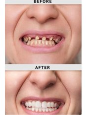 Dental Implants - Phillip Island Dental