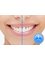 Melbourne Dentist - In-Chair teeth whitening - a quick and easy option that can be completed in a lunch hour and gives instant results that can be significanly lighter than your natural base shade. 