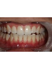 Zoom! Teeth Whitening - Claremont Dental