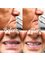 Total Denture Care - New Dentures 