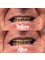 Total Denture Care - Denture Repair - Chipped tooth 