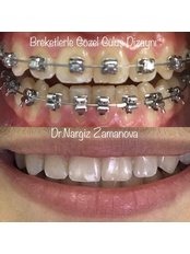 Metal Braces - 32 Beauty Billur Dent MMC