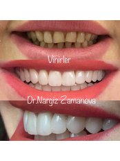 Veneers - 32 Beauty Billur Dent MMC