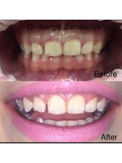 Gum treatment - 32 Beauty Billur Dent MMC