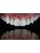 Best Dental Brace & Implant Clinic - E Max Veneer 
