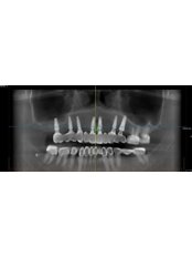Dental Implants - Best Dental Brace & Implant Clinic