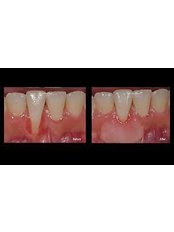 Gum Surgery - Brace Orthodontics & Dental Care - Bashundhara R/A
