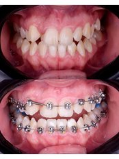 Braces - Brace Orthodontics & Dental Care - Bashundhara R/A