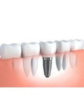 Dental Implants - Dental Brace & Implant Clinic