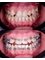 Dental Brace & Implant Clinic - reposotioning palatally palce teeth 