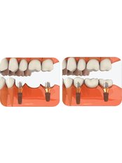 Implant Bridge - Dental City & Orthodontics