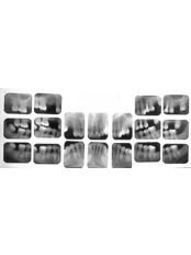 Dental X-Ray - Dental City & Orthodontics