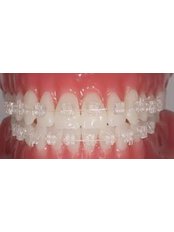 Clear Braces - Dental City & Orthodontics