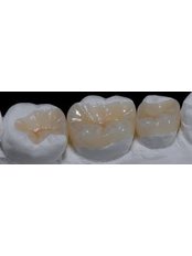 Composite Resin Inlay or Onlay - Dental City & Orthodontics