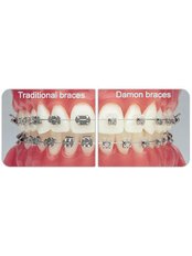 Damon™ Braces - Dental City & Orthodontics