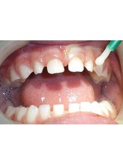 Fluoride Therapy - Dental City & Orthodontics