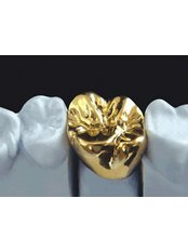Gold Alloy Crown - Dental City & Orthodontics