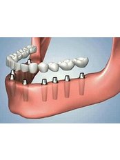 Implant Bridge - Dental City & Orthodontics