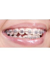 Fixed Braces - Dental City & Orthodontics