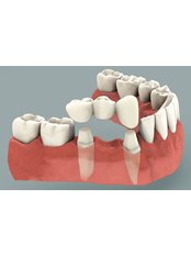 Dental Bridges - Dental City & Orthodontics