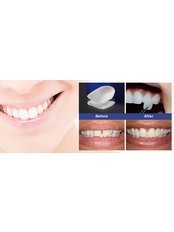 Composite Veneers - Dental City & Orthodontics