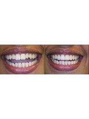 Total smile Makeover - Luxadent Dental Office - Johan Willemsens