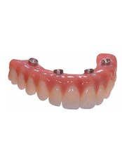 Dental Implants - Luxadent Dental Office - Johan Willemsens