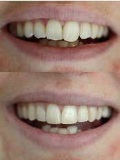 Smile Makeover - Luxadent Dental Office - Johan Willemsens