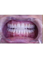 Teeth Whitening - Luxadent Dental Office - Johan Willemsens