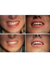 Composite Veneers - Kostadinovic Dentistry