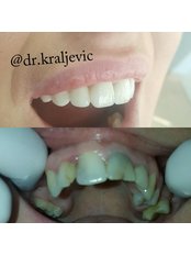 Dental Bridges - Dental & Aesthetics Medicine Center Kraljević