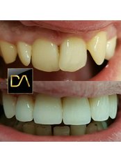 Dental Crowns - Dental & Aesthetics Medicine Center Kraljević