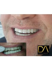 Dental Crowns - Dental & Aesthetics Medicine Center Kraljević