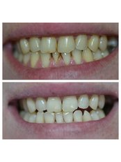 Teeth Cleaning - Stomatološka Ordinacija Dr Kamenica