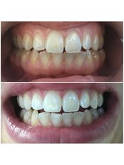 Laser Teeth Whitening - Stomatološka Ordinacija Dr Kamenica