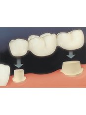 Dental Bridges - Dr. Luiz Alberto Ferraz de Caldas - Unidade Miguel Pereira - Miguel Pereira Branch